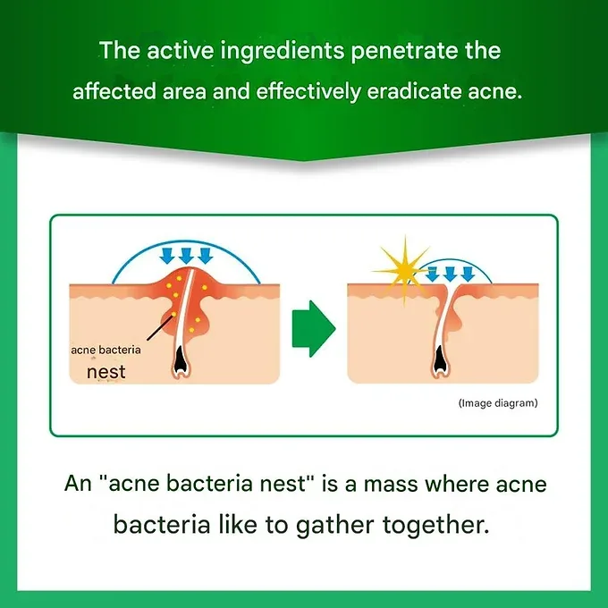 Mentholatum Acnes 25 Medical Mist b 100mL